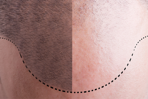 dhi hair transplant