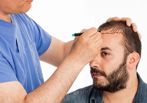 fue hair transplant