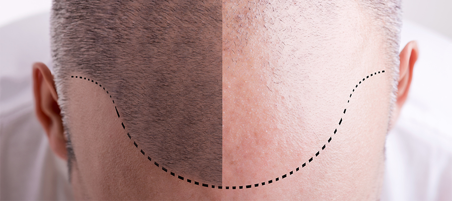 dhi hair transplant
