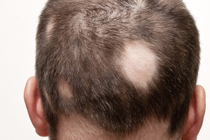 what is alopecia areata how is it treated