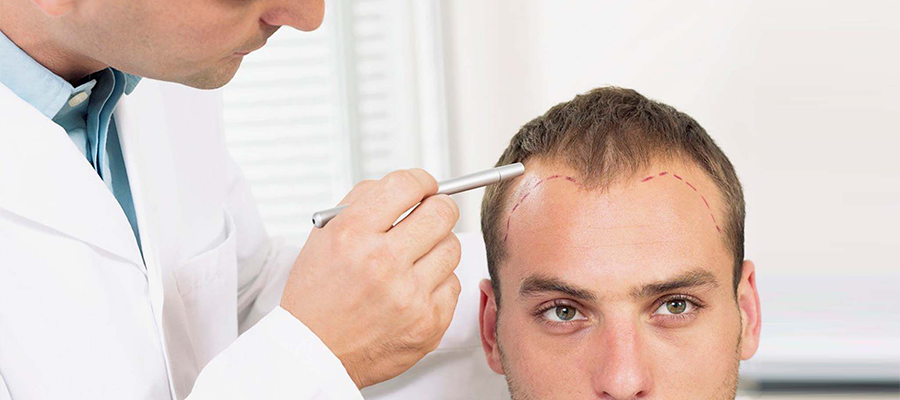 how to wash your hair after hair transplant