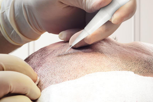 what is the best hairtransplant technique